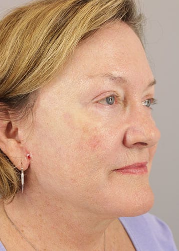Face Lift Patient 35 - After 