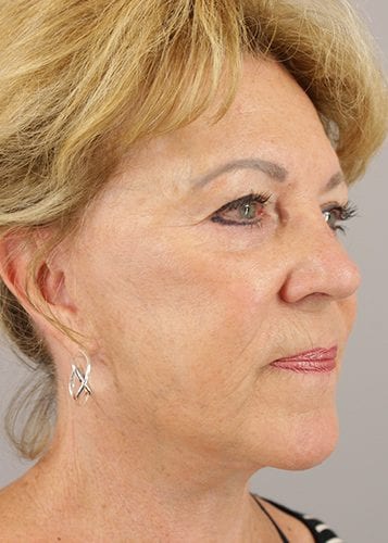 Face Lift Patient 34 - After 