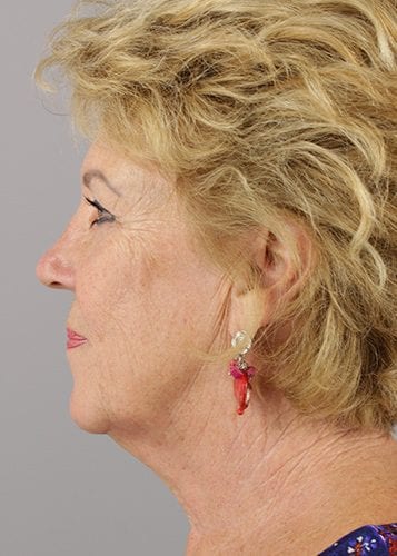 Face Lift Patient 34 - Before 