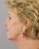 Face Lift Patient 34 - Before Thumbnail 