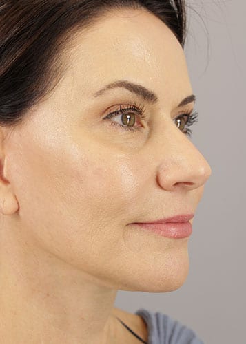 Face Lift Patient 36 - After 2