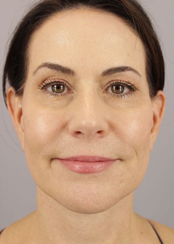 Face Lift Patient 36 - After 