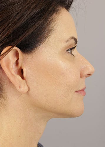 Face Lift Patient 36 - After 