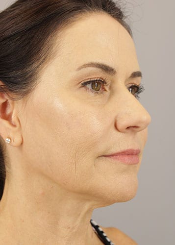 Face Lift Patient 36 - Before 2