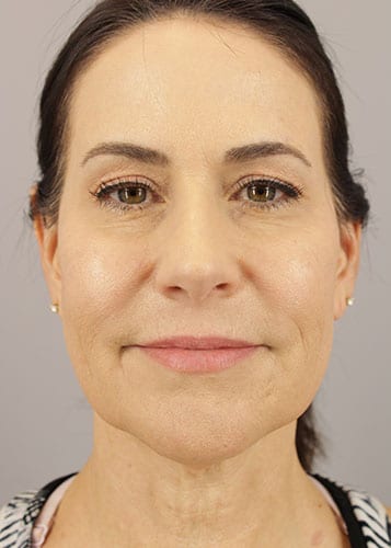 Face Lift Patient 36 - Before 
