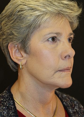 Face Lift Patient 09 - After 