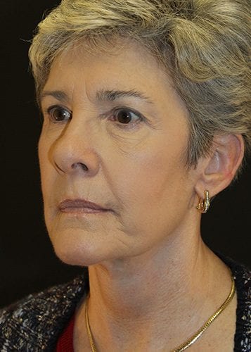 Face Lift Patient 09 - After 