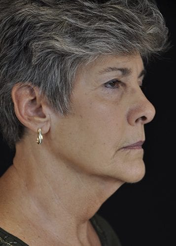 Face Lift Patient 09 - Before 