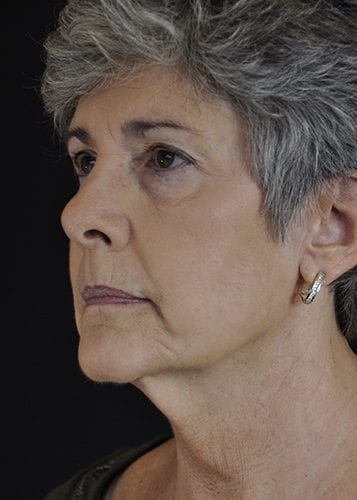 Face Lift Patient 09 - Before 