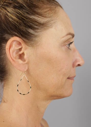 Face Lift Patient 02 - Before 