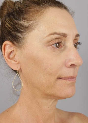 Face Lift Patient 02 - Before 