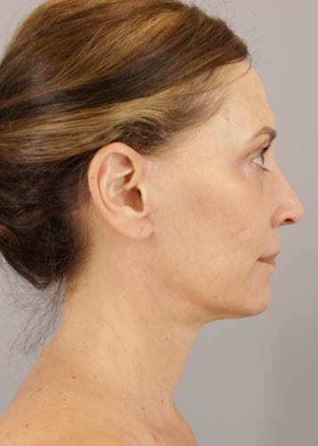 Face Lift Patient 02 - After 
