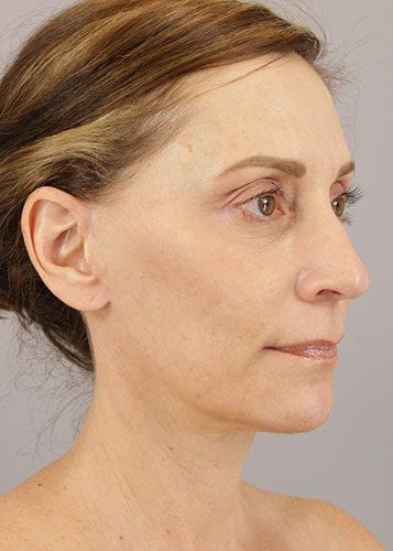 Face Lift Patient 02 - After 