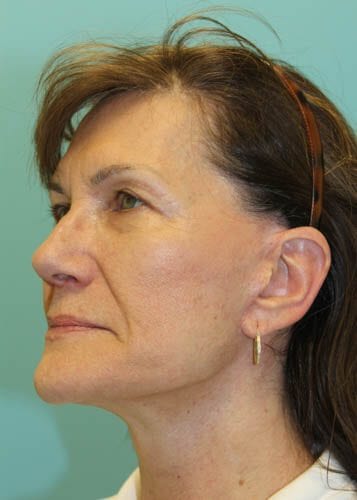 Face Lift Patient 03 - After 