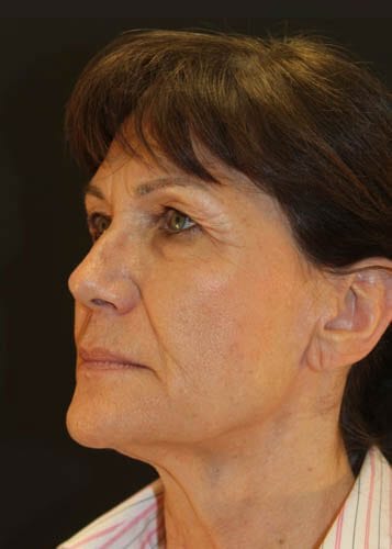 Face Lift Patient 03 - Before 