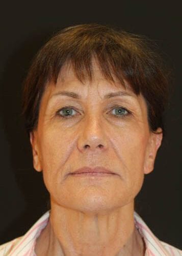 Face Lift Patient 03 - Before 