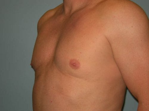 Gynecomastia Patient 03 - After 