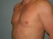 Gynecomastia Patient 03 - After Thumbnail 