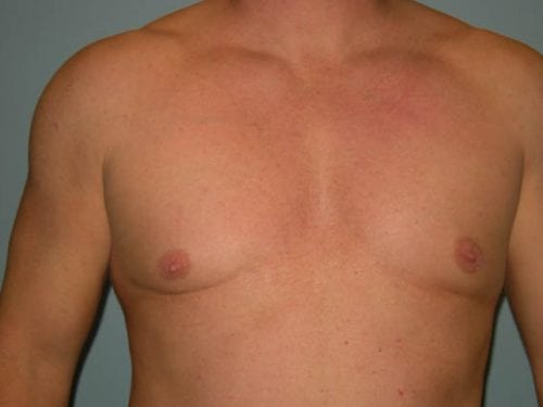 Gynecomastia Patient 03 - After 