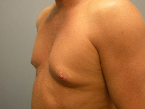 Gynecomastia Patient 03 - Before 