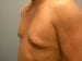 Gynecomastia Patient 03 - Before Thumbnail 