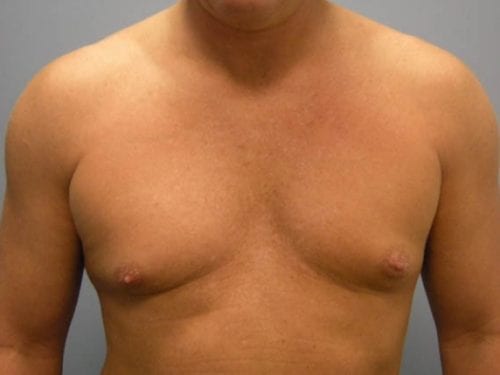 Gynecomastia Patient 03 - Before 