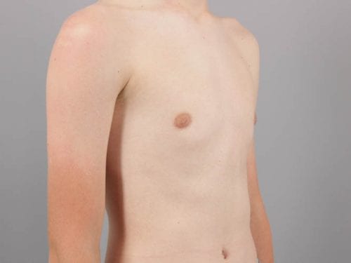 Gynecomastia Patient 02 - After 
