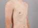 Gynecomastia Patient 02 - After Thumbnail 