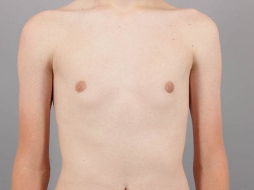 Gynecomastia Patient 02 - After 