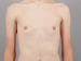 Gynecomastia Patient 02 - After Thumbnail 