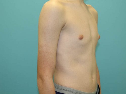 Gynecomastia Patient 02 - Before 