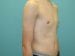 Gynecomastia Patient 02 - Before Thumbnail 