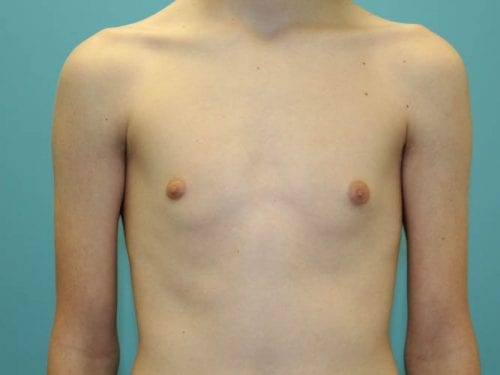 Gynecomastia Patient 02 - Before 