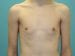 Gynecomastia Patient 02 - Before Thumbnail 