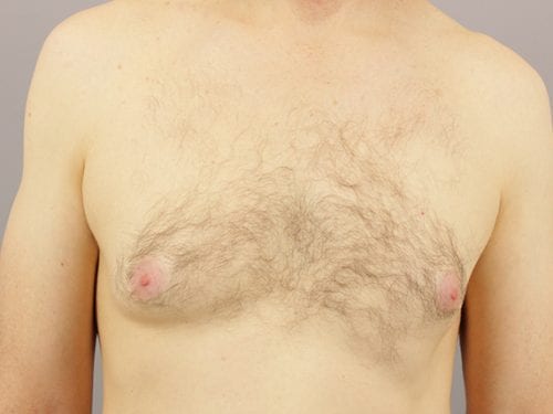 Gynecomastia Patient 04 - After 