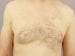 Gynecomastia Patient 04 - After Thumbnail 