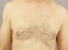Gynecomastia Patient 04 - Before Thumbnail 