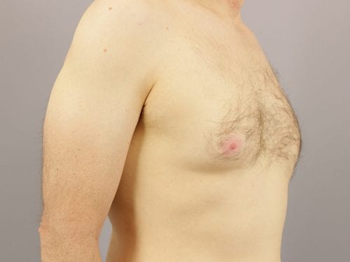 Gynecomastia Patient 04 - After 2