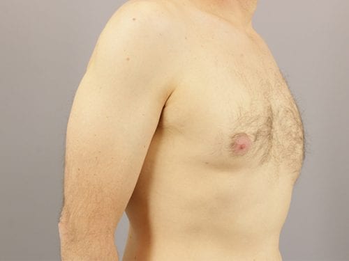 Gynecomastia Patient 04 - Before 2