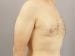 Gynecomastia Patient 04 - Before Thumbnail 
