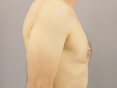 Gynecomastia Patient 04 - After 