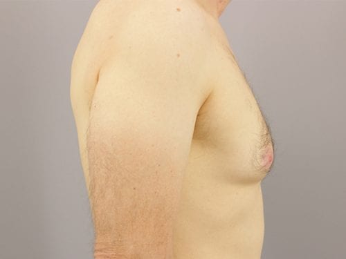 Gynecomastia Patient 04 - Before 