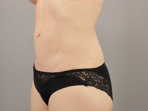 Liposuction Patient 11 - After 