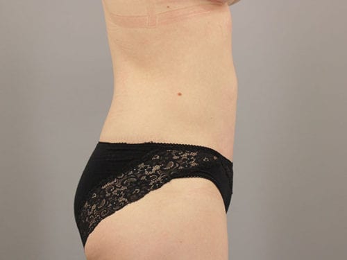 Liposuction Patient 11 - After 