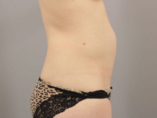 Liposuction Patient 11 - Before 