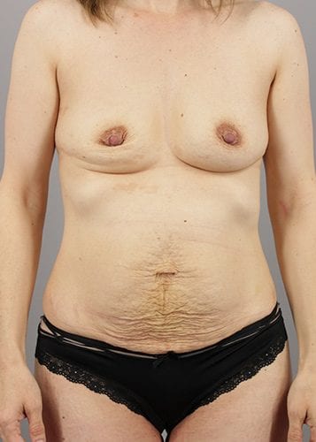 Mommy Makeover Patient 10 - Before 