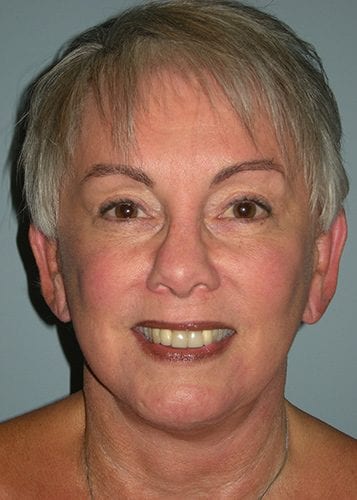 Neck Lift Patient 01 - After 