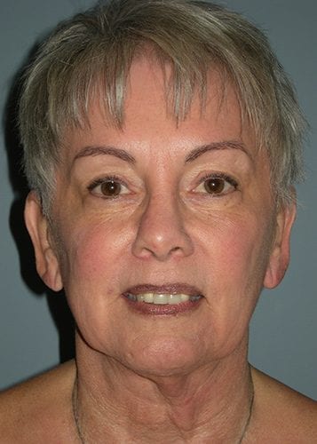 Neck Lift Patient 01 - Before 