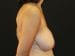 Breast Reduction Patient 03 - Before Thumbnail 