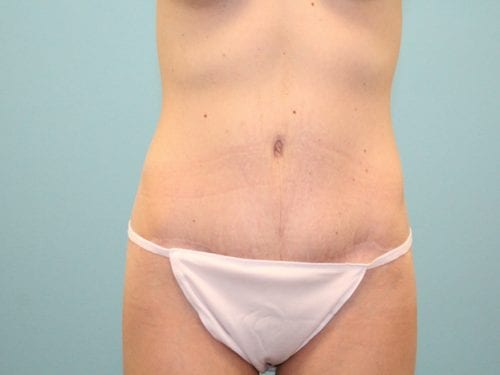 Tummy Tuck Patient 06 - After 